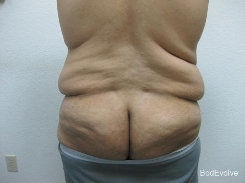 Patient 3 - Cosmetic Surgery After Massive Weight Loss - Before 5
