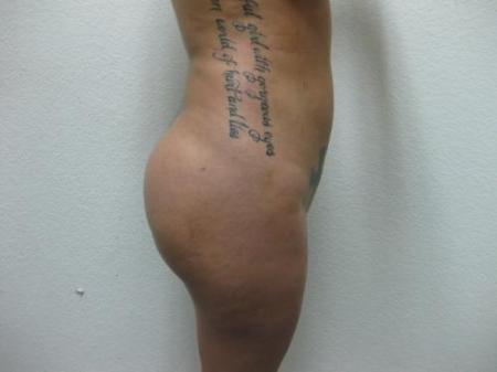 Brazilian Butt Lift - Patient 3 - Before Image 5