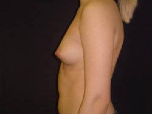 Breast Augmentation - Patient 15 - Before and After 3