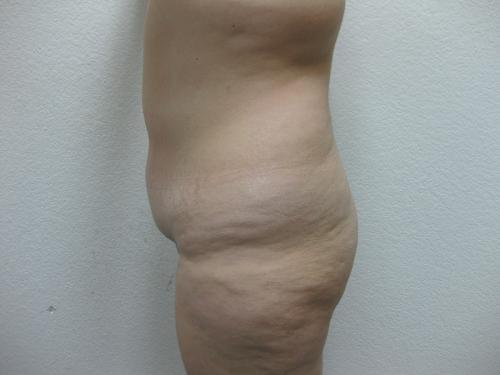 Liposuction - Patient 3 - Before 3