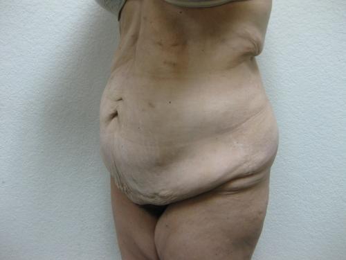 Patient 15 - Cosmetic Surgery After Massive Weight Loss - Before 2