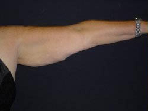 Arm Lift Surgery - Patient 2 - Before