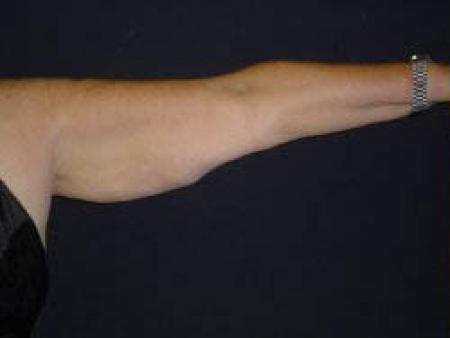 Arm Lift Surgery - Patient 2 - Before