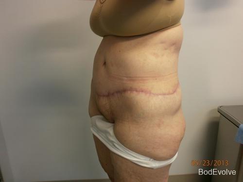 Body Lift - Patient 4 - After 2