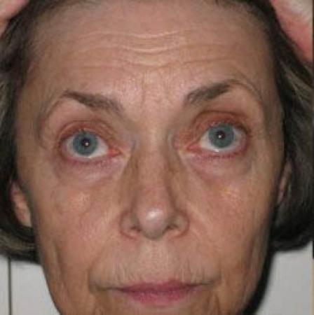 Facelift - Patient 2 - Before Image 6