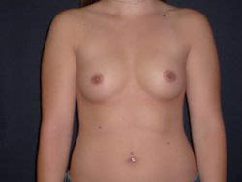 Breast Augmentation - Patient 11 - Before 1