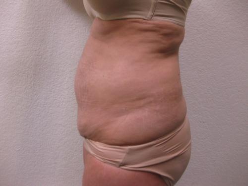Tummy Tuck - Patient 4 - Before 4