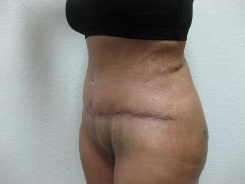 Patient 9 - Cosmetic Surgery After Massive Weight Loss -  After 2