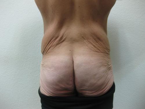 Body Lift - Patient 5 - Before 5