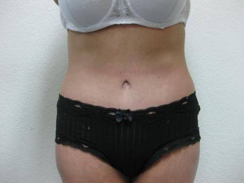 Tummy Tuck - Patient 2 -  After 1