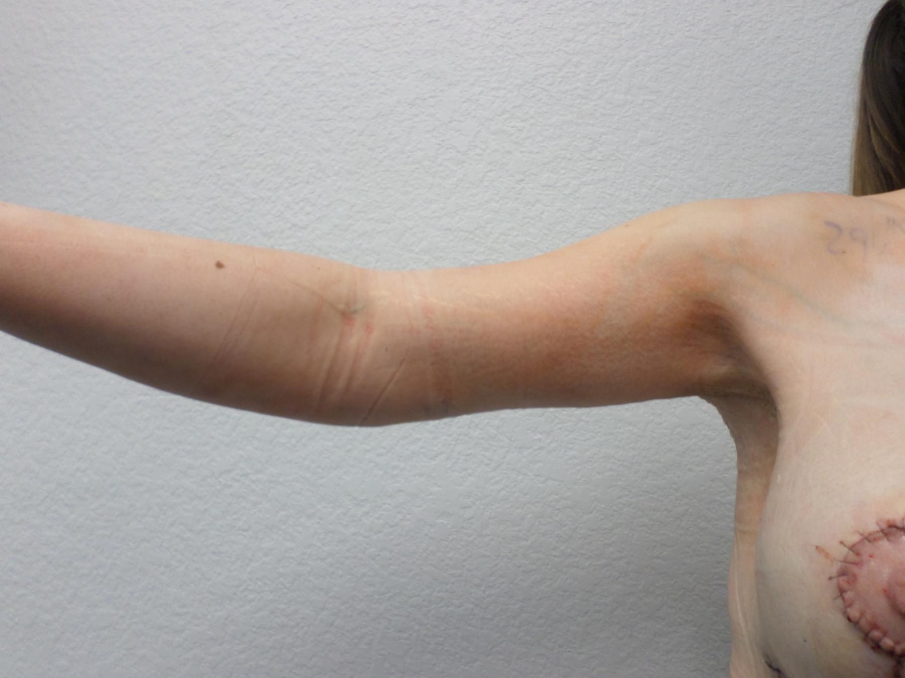 Arm Lift: Patient 8 - After 3