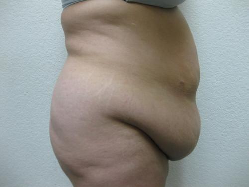 Patient 10 - Cosmetic Surgery After Massive Weight Loss - Before and After 5