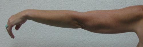 Arm Lift Surgery - Patient 3 -  After 3