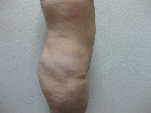 Liposuction - Patient 3 -  After 6