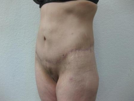 Body Lift - Patient 8 - After Image 8