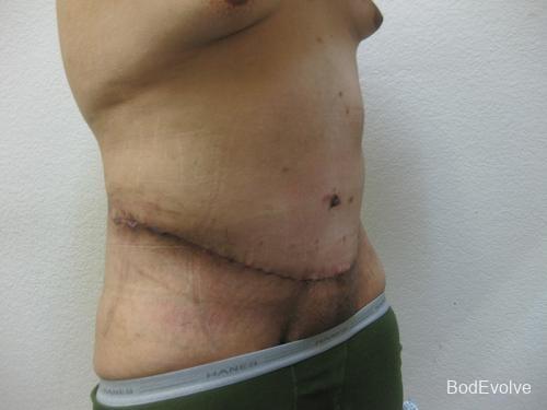 Body Lift - Patient 1 - After 8