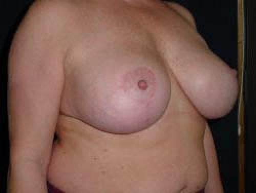 Breast Augmentation with Lift - Patient 6 -  After 2