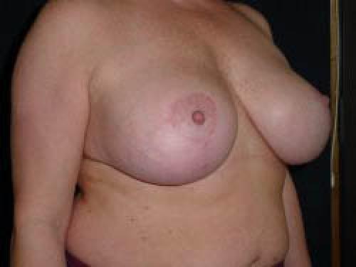 Breast Augmentation with Lift - Patient 6 - After 2