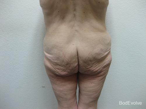 Patient 5 - Cosmetic Surgery After Massive Weight Loss - Before 6