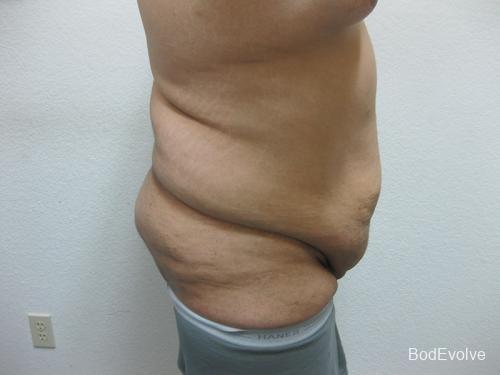 Body Lift - Patient 1 - Before 7