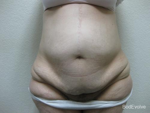Patient 4 - Cosmetic Surgery After Massive Weight Loss - Before