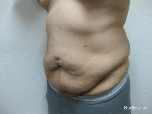 Patient 3 - Cosmetic Surgery After Massive Weight Loss - Before 2