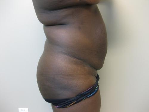 Tummy Tuck - Patient 5 - Before and After 5