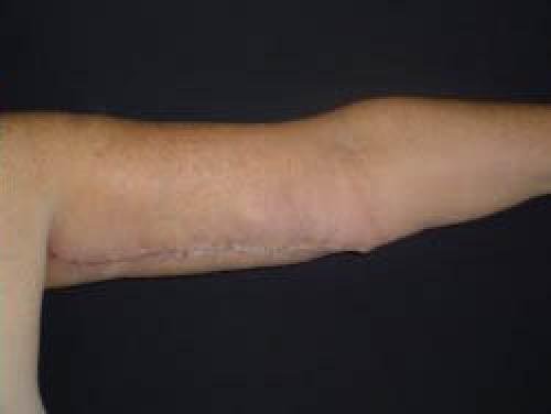 Arm Lift Surgery - Patient 2 - After 