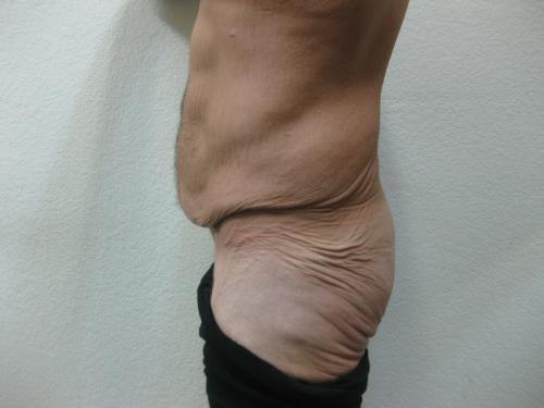 Body Lift - Patient 5 - Before 4