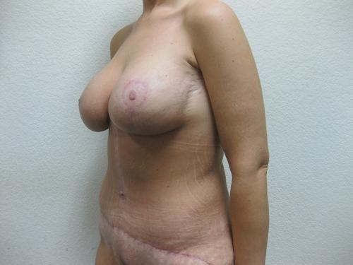 Cosmetic Surgery After Massive Weight Loss -  After 2
