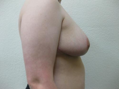 Breast Reduction - Patient 2 -  After 6