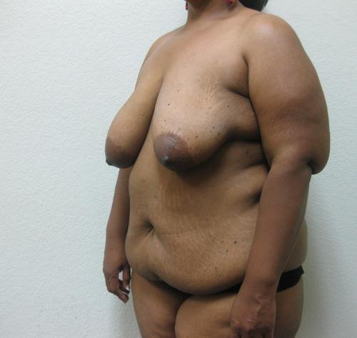 Breast Reduction - Patient 6 - Before 2