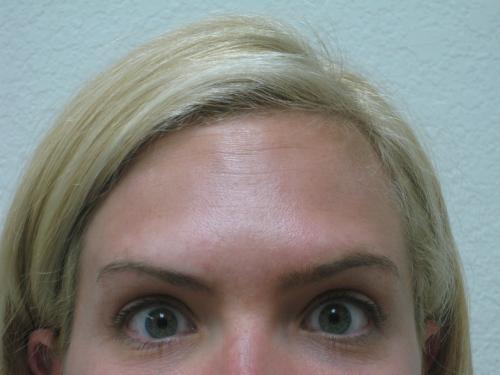 Botox - Patient 2 - After 