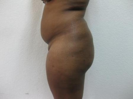 Brazilian Butt Lift - Patient 2 - Before Image 1