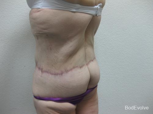 Patient 6 - Cosmetic Surgery After Massive Weight Loss -  After 5