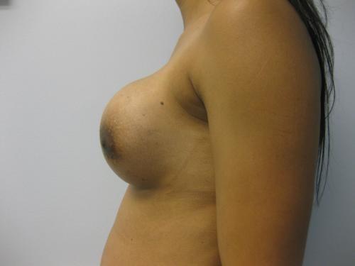 Breast Revision - Patient 2 - Before and After 3