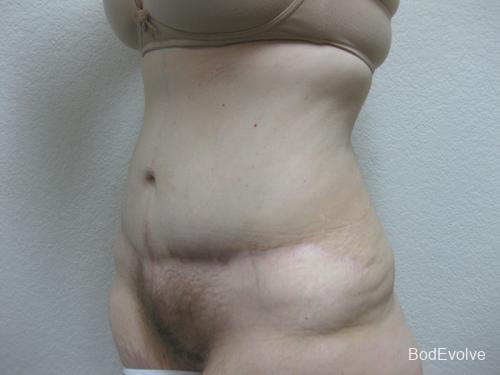 Patient 4 - Cosmetic Surgery After Massive Weight Loss -  After 2