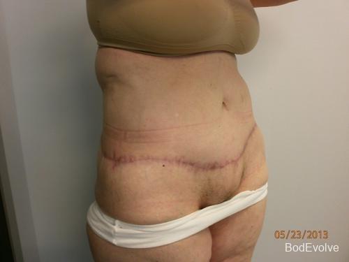 Patient 7 - Cosmetic Surgery After Massive Weight Loss -  After 7