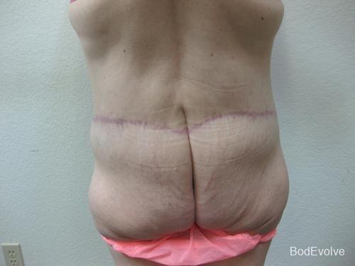 Patient 5 - Cosmetic Surgery After Massive Weight Loss -  After 6