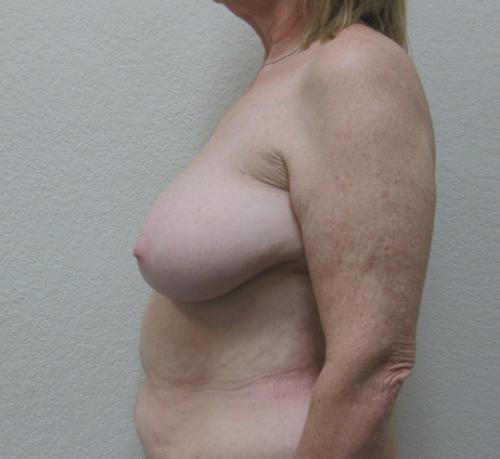 Breast Reduction - Patient 4 - Before and After 3