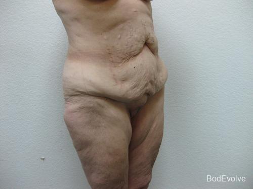 Patient 5 - Cosmetic Surgery After Massive Weight Loss - Before and After 8