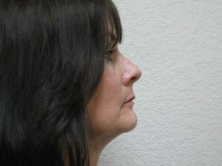 Lip Augmentation - Patient 2 - Before Image 3