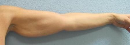 Arm Lift Surgery - Patient 3 - Before Image 8
