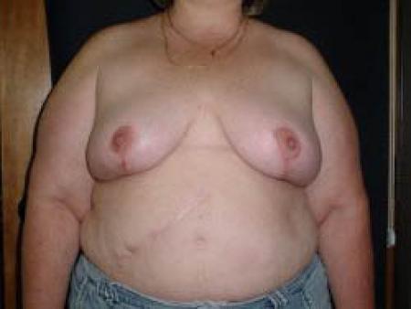 Breast Reduction - Patient 5 - After 