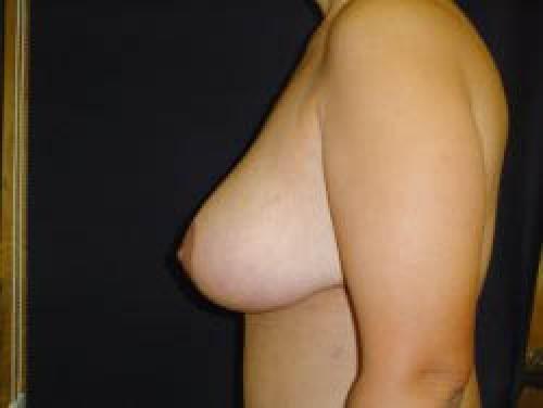 Breast Augmentation with Lift - Patient 9 - After 3