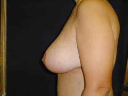 Breast Augmentation with Lift - Patient 9 - After Image 3