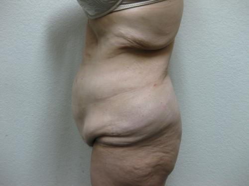 Patient 15 - Cosmetic Surgery After Massive Weight Loss - Before 3