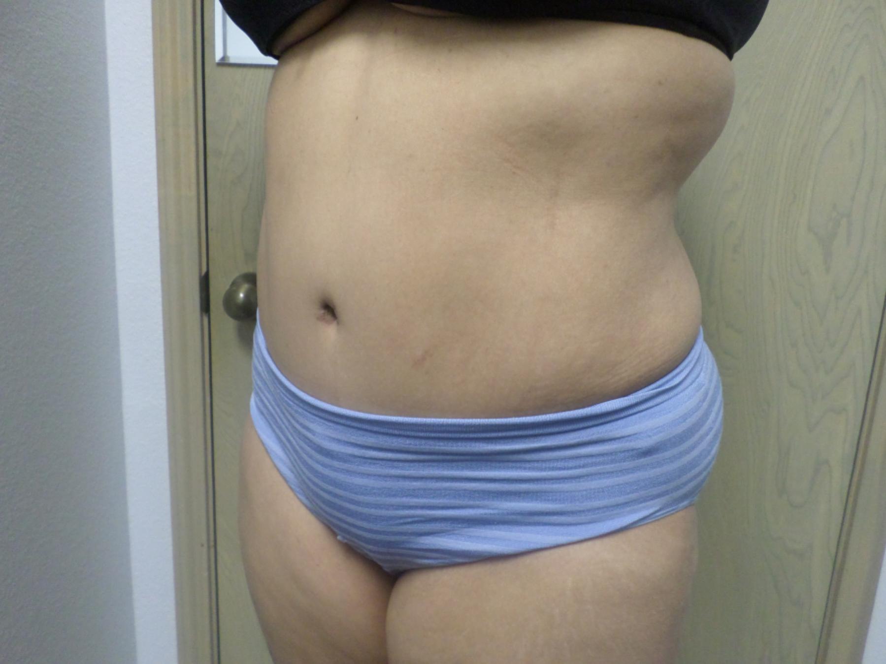 Liposuction: Patient 16 - After 2
