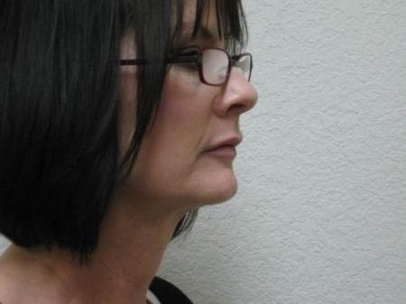 Lip Augmentation - Patient 2 - After Image 2