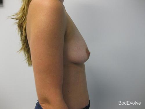 Breast Augmentation - Patient 1 - Before and After 5